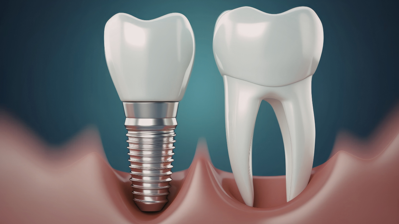 Exemplo de implante dentário unitário